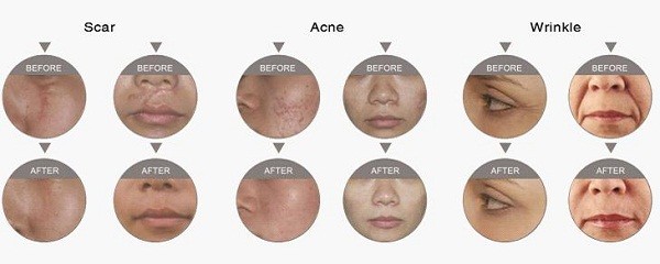 Effectively 10600 Nm Stretch Mark Removal Machine For Tighten Skin / Lift Face