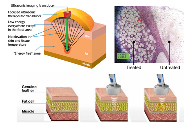 Sales Agent WANTED!!! hifu machine/ high intensity focused ultrasound