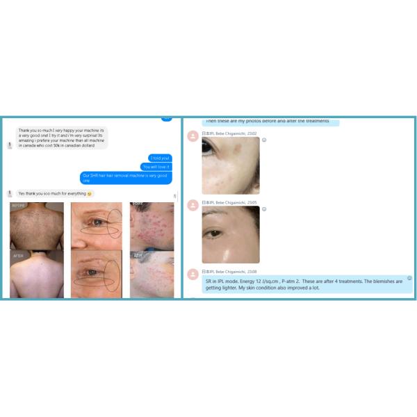 APT advaned automatic hair washing aesthetics beauty ipl anti acne treatments machine