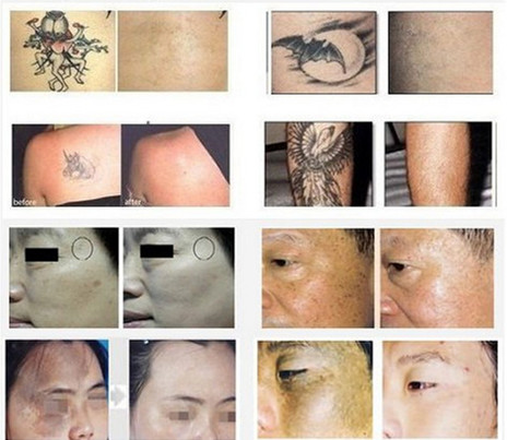 Portble Q Switch ND YAG Laser Tattoo Removal Equipment 1064nm / 532nm / 1320nm Laser Beauty Machine