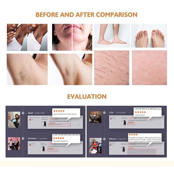 Stationary Anybeauty SFDA 808nm Diode Laser Hair Removal Machine