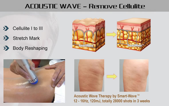 Skin Tighten & Stretch Marks & Cellulite Treatment Acoustic Wave Therapy Equipment