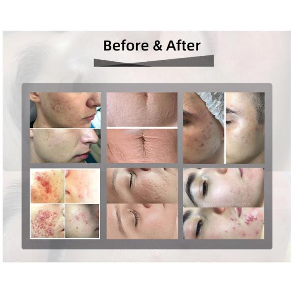 10600nm Co2 Fractional Laser Machine Vaginal Tightening Scar Removal