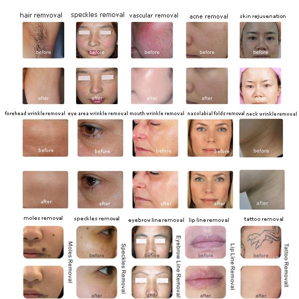 YR402 New Multifunctional Beauty Machine opt+ipl+rf+nd.yag laser