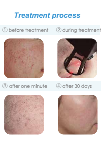 Medical device 10600nm laser vaginal co2 laser machine for wrinkle spot scar pigment removal