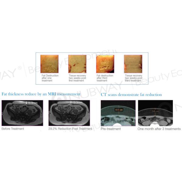 2016 HIFUSHAPE High Focus Ultrasonic Liposuction hifu body slimming beauty equipment