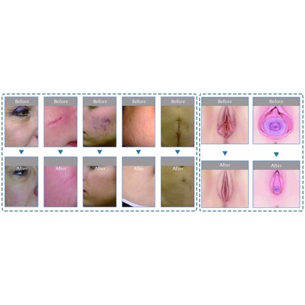 Vertical F7+ Vaginal Co2 fractional laser machine for vaginal tighten , skin resurfacing , acne scare removal