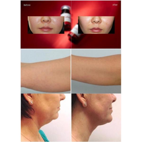 8ml/Bottle X 5 Bottle Lipolysis Solution