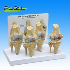 China 4-Stage Osteo-Arthritic Knee Anatomical Model Anatomical Model on sale