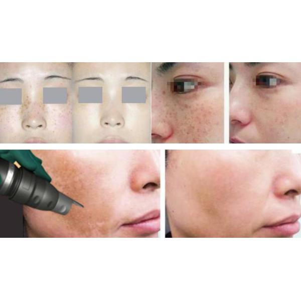 CE ISO Approved E Light IPL RF Hair Removal Medical Beauty Machine