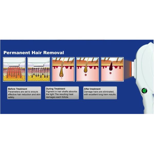 Advanced SHR + ND yag laser hair and tattoo removal machine with Touch Screen