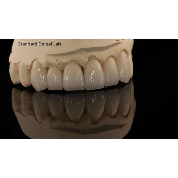 Complete Denture Ivoclar Full Denture Acrylic Teeth SDL Dental Lab