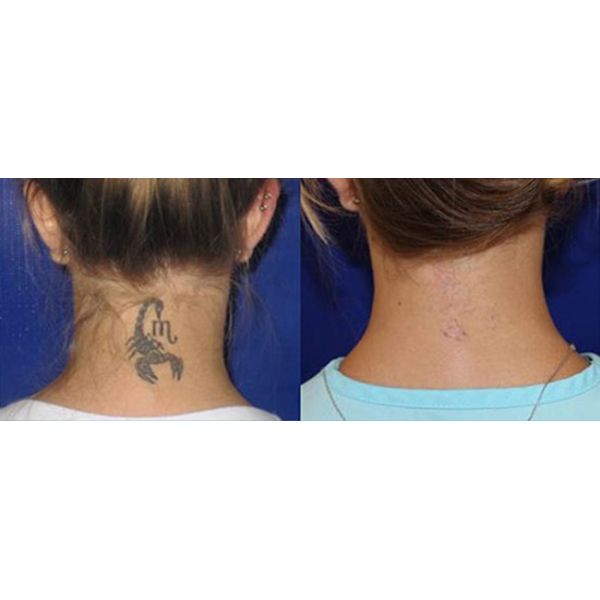 Q Switch ND YAG Laser Tattoo Removal Machine Picway Picosecond Laser