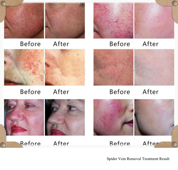 spider veins laser removal machine for leg vein face vein and all kinds of spider vein removal treatment