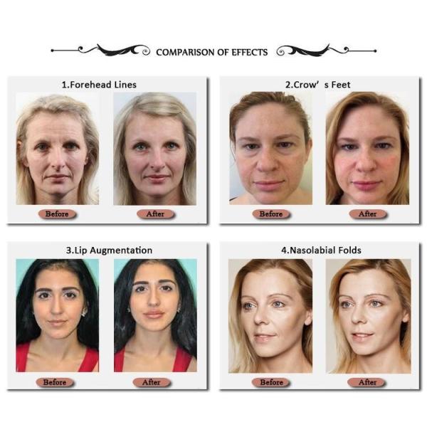 Natural Plla Dermal Filler Face Poly L Lactic Acid Fillers CE