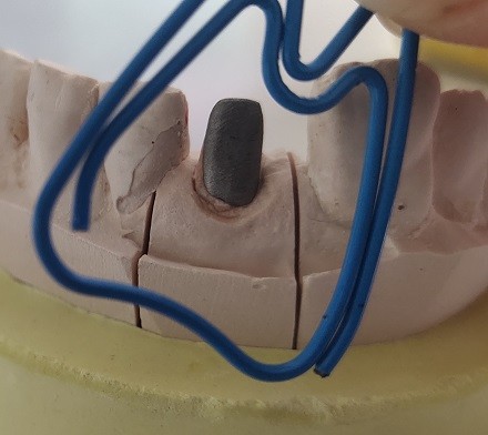Metal Dental Post And Core After Endodontic Treatment