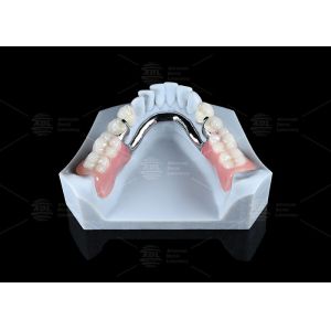 Cheap Adjustable Multi Functional ERA Precision Attachment Removable ERA Attachments For Dentures wholesale