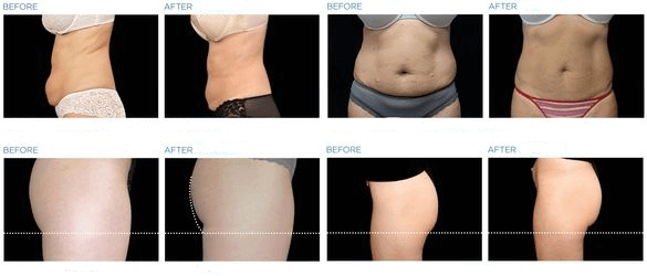 Hip Muscle Contraction ED Therapy Machine With TFT Touch Screen