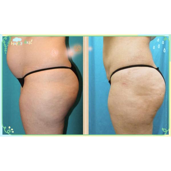 Red Lipolytic Solution 5x10ml Fat Reducing Injections