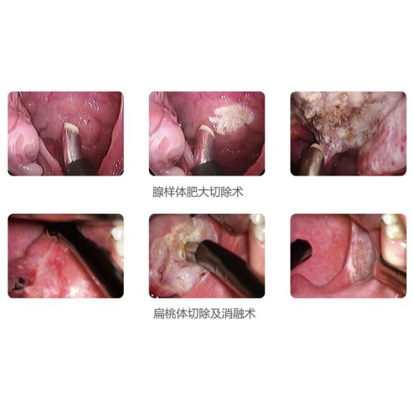 Low Temperature RF Plasma Surgery System Minimal Invasive Cryosurgery Unit