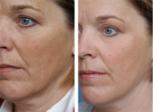 Clinic Salon Portable CO2 Fractional Laser Machine Beauty Salon Equipment For Acne Removal