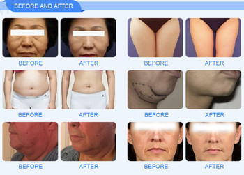 Hifu 7d Ultramax Smas Face Lifting Machine Cartridges 20000 Shots