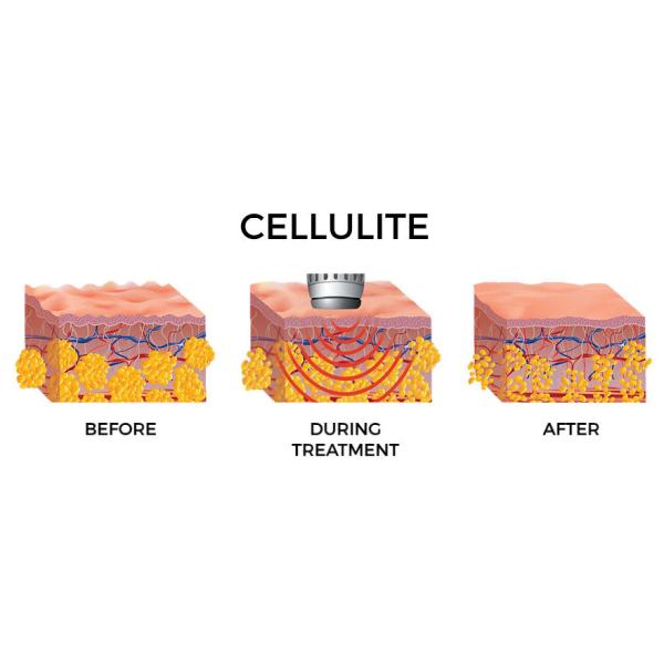 High Intensity Extracorporeal Shock Wave Therapy Equipment Shockwave Machine