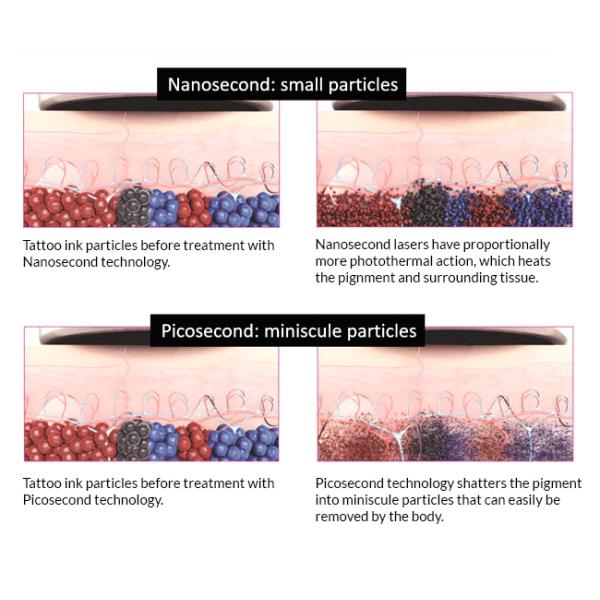 2019 newest techniques Korean imported picosecond laser price