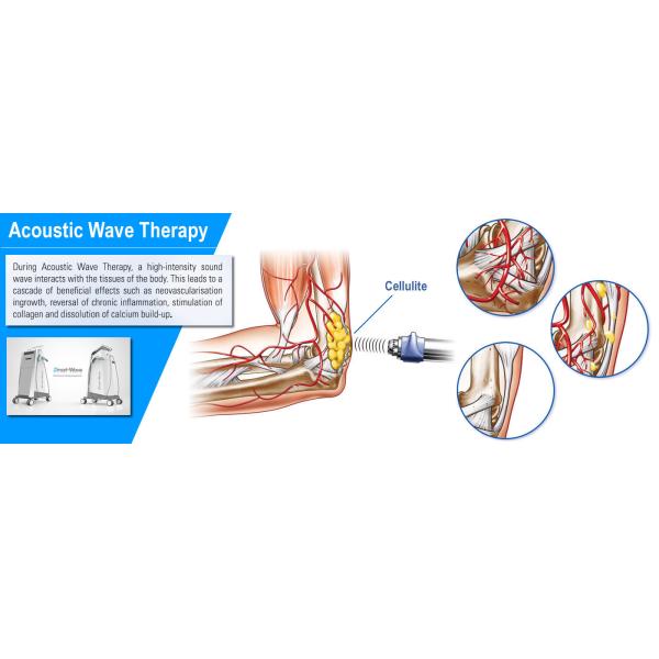 Continuously Muscle And Connective Tissue Tightening With Radial Acoustic Shockwave
