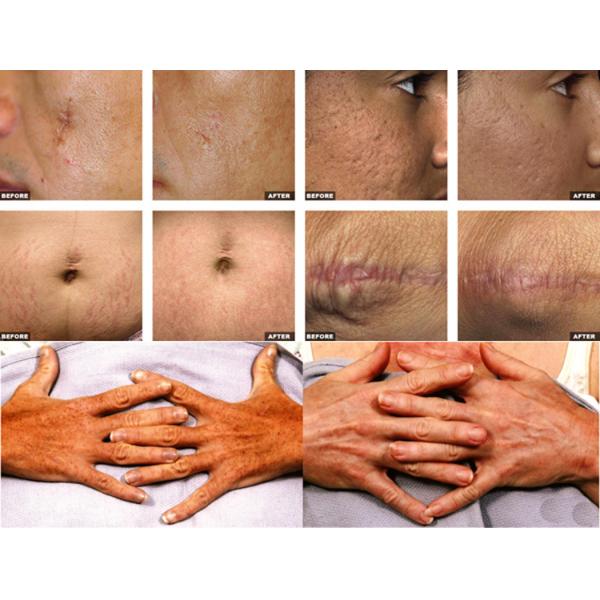 Medical device 10600nm laser vaginal co2 laser machine for wrinkle spot scar pigment removal