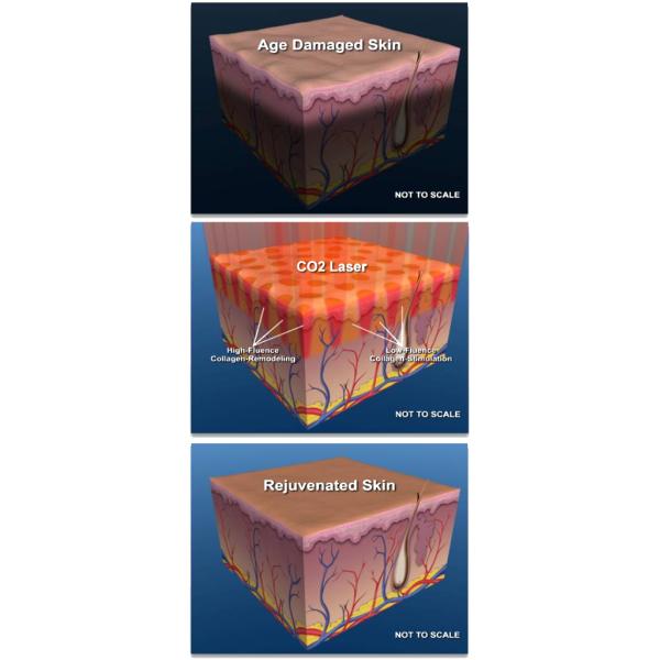 Laser Skin Resurfacing: YAG and Fractionated CO2