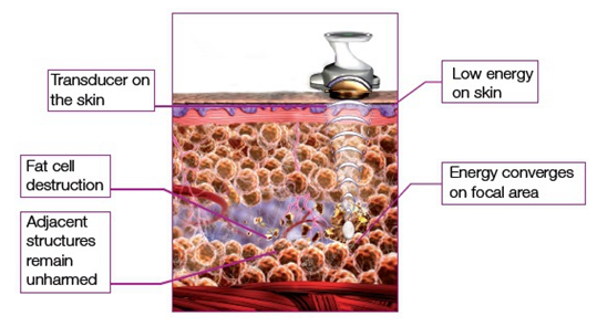 Sales Agent WANTED!!! hifu machine/ high intensity focused ultrasound