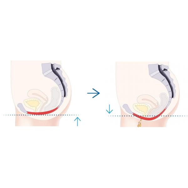 Hip Muscle Contraction ED Therapy Machine With TFT Touch Screen