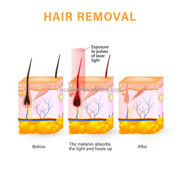 3 In 1 Stationary 808 Laser Hair Removal Machine 220v Diode Alexandrite