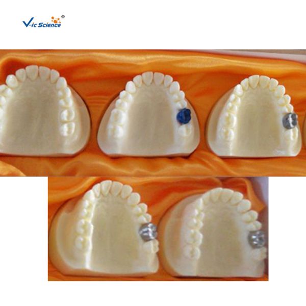 Quality Producing Steps Of Marilan Bridge Dental Study Models For Teeth Teaching for sale