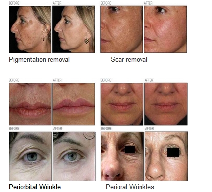 Nubway Top Quality Fractional CO2 40w Co2 For Beauty Clinic Use Medical Laser Treatment Equipment