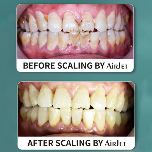 Portable Aluminum Prophy Jet Dental , Multipurpose Prophy Air Polisher