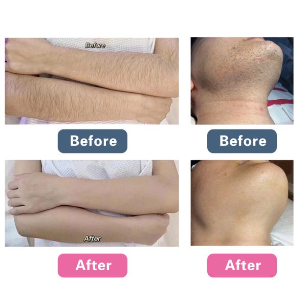 2000w Diode Laser Depilation 50% off Sep Promotion with 4 Wavelengths 808 755 940 1064nm