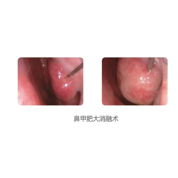 Low Temperature RF Plasma Surgery System Minimal Invasive Cryosurgery Unit